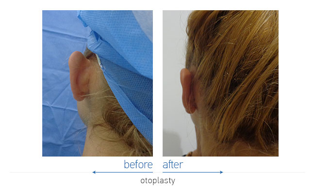 Otoplasty Before and After