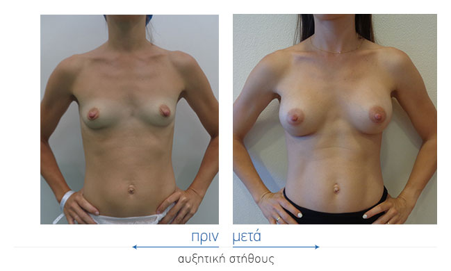 Breast Augmentatntion Before and After