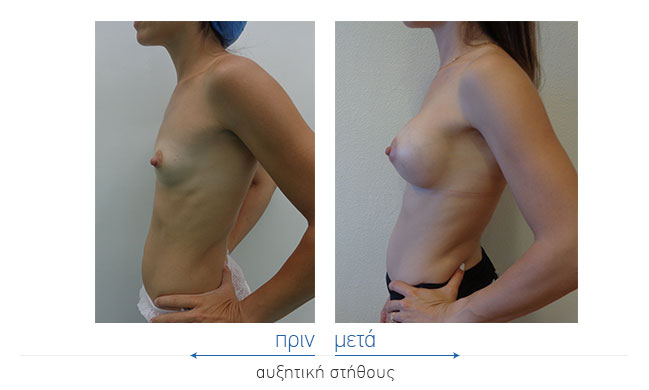 Breast Augmentatntion Before and After
