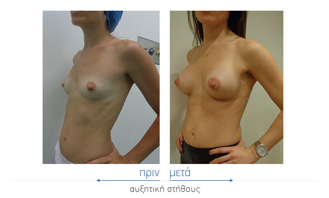 Breast Augmentatntion Before and After