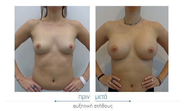 Breast Augmentatntion Before and After