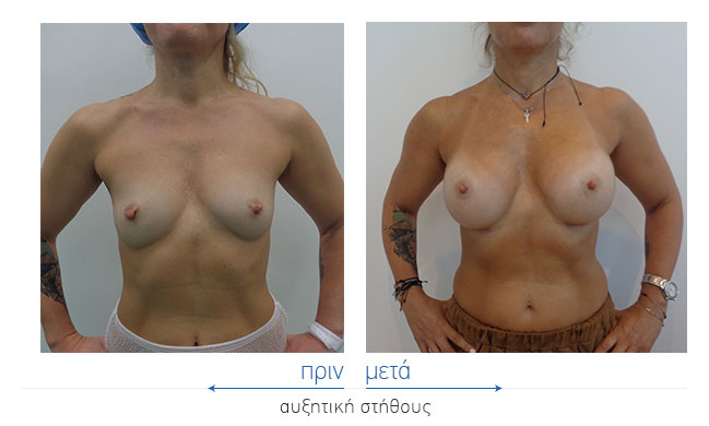 Breast Augmentatntion Before and After