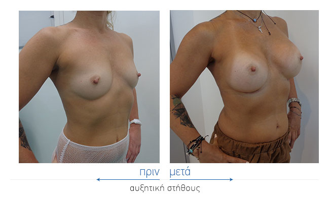 Breast Augmentatntion Before and After