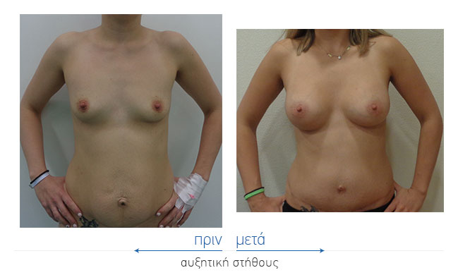 Breast Augmentatntion Before and After