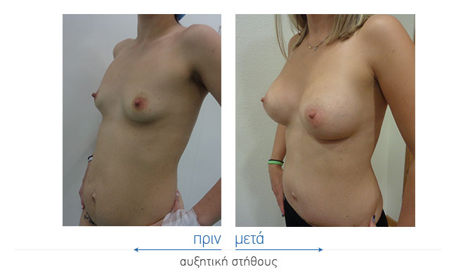 Breast Augmentatntion Before and After