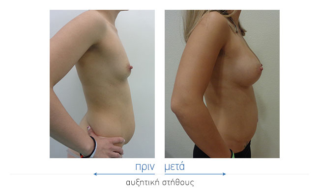Breast Augmentatntion Before and After