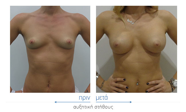 Breast Augmentatntion Before and After