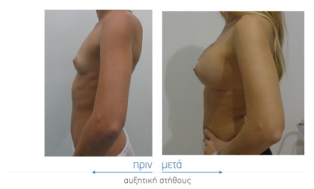 Breast Augmentatntion Before and After