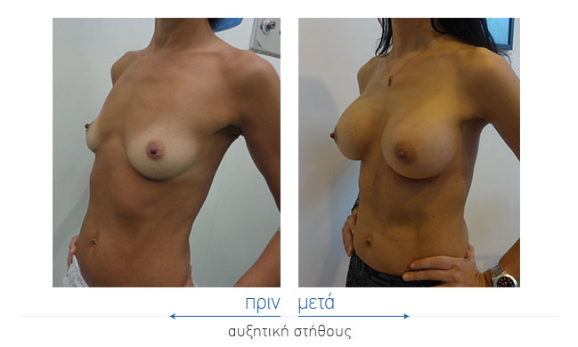 Breast Augmentatntion Before and After