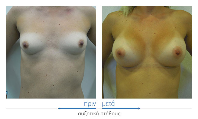 Breast Augmentatntion Before and After
