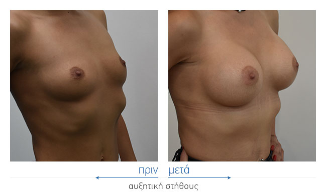 Breast Augmentatntion Before and After