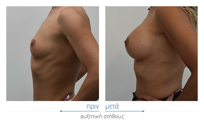 Breast Augmentatntion Before and After