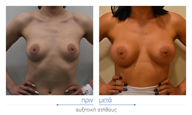 Breast Augmentatntion Before and After