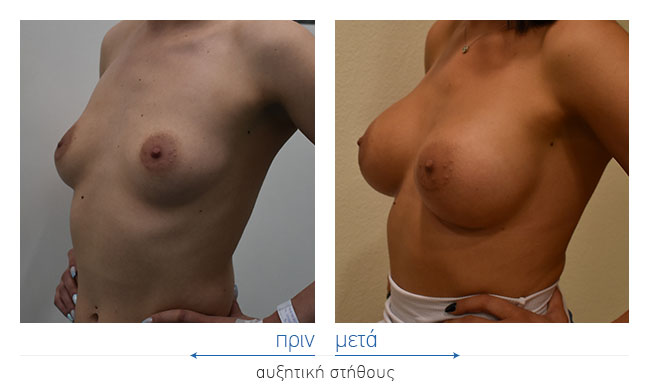 Breast Augmentatntion Before and After