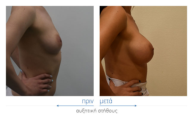 Breast Augmentatntion Before and After