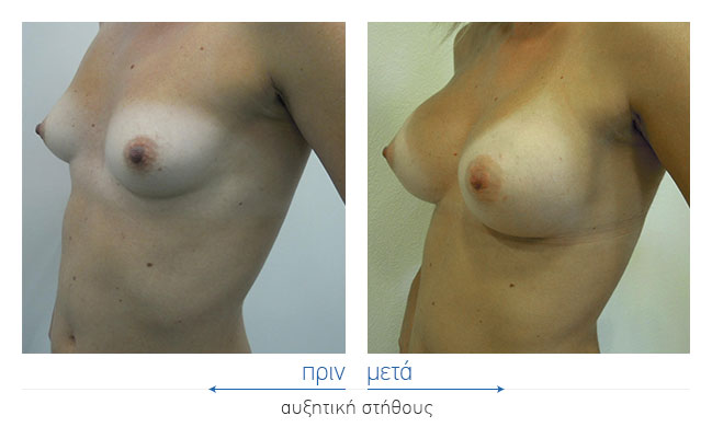 Breast Augmentatntion Before and After