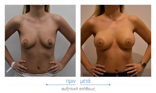 Breast Augmentatntion Before and After