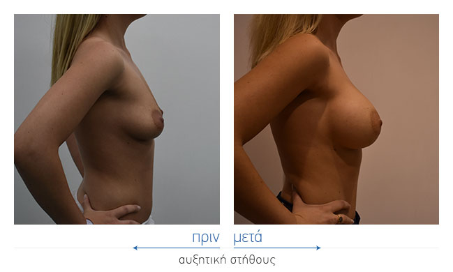 Breast Augmentatntion Before and After