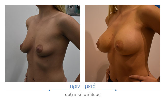 Breast Augmentatntion Before and After