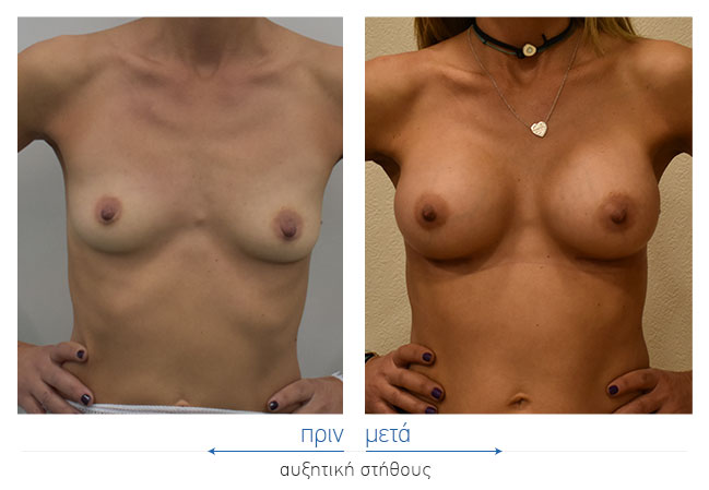Breast Augmentatntion Before and After