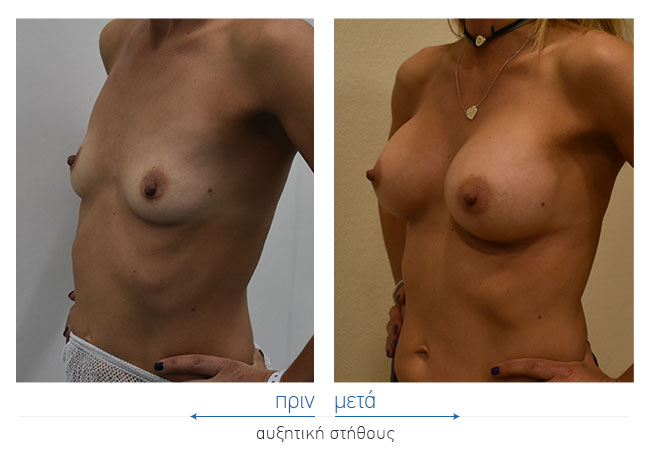 Breast Augmentatntion Before and After
