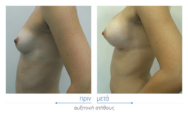 Breast Augmentatntion Before and After