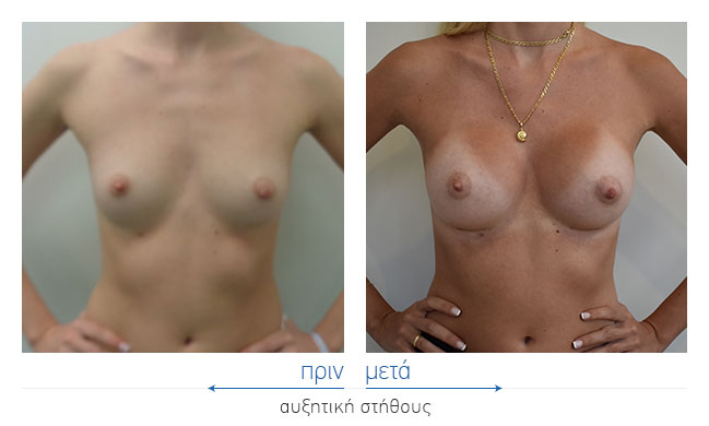 Breast Augmentatntion Before and After