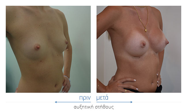 Breast Augmentatntion Before and After
