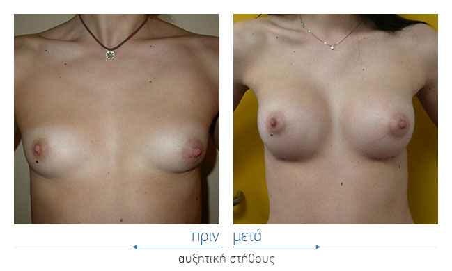 Breast Augmentatntion Before and After