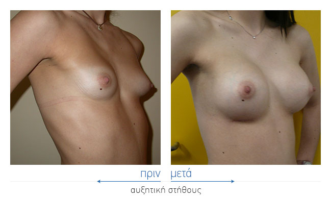 Breast Augmentatntion Before and After