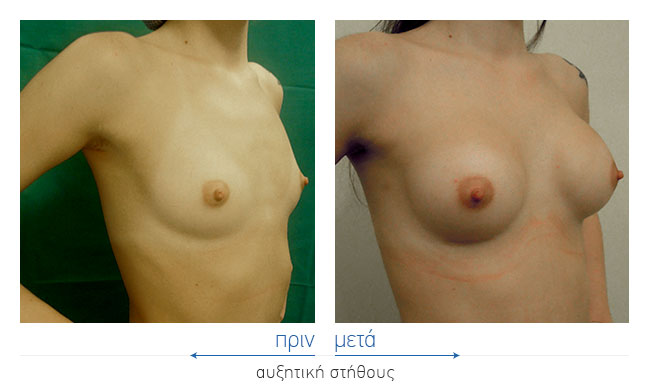 Breast Augmentatntion Before and After