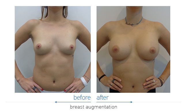 Breast Augmentatntion Before and After