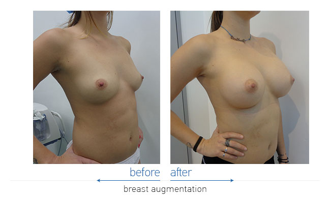 Breast Augmentatntion Before and After