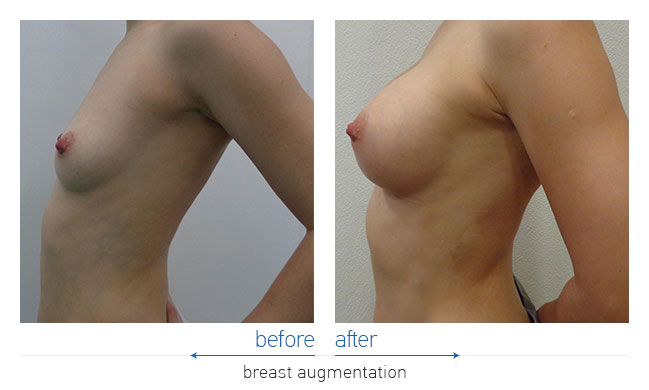 Breast Augmentatntion Before and After