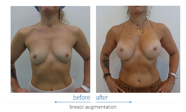 Breast Augmentatntion Before and After