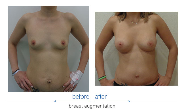 Breast Augmentatntion Before and After
