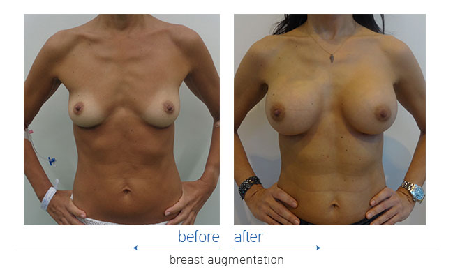 Breast Augmentatntion Before and After