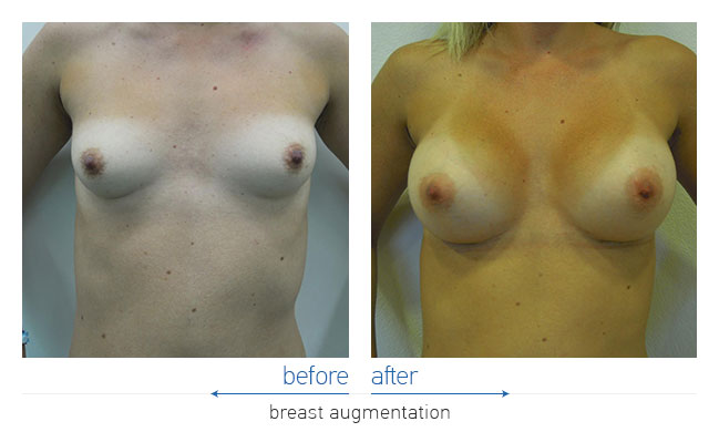 Breast Augmentatntion Before and After