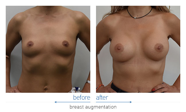 Breast Augmentatntion Before and After