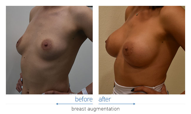 Breast Augmentatntion Before and After