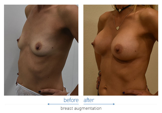 Breast Augmentatntion Before and After