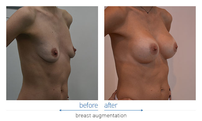 Breast Augmentatntion Before and After