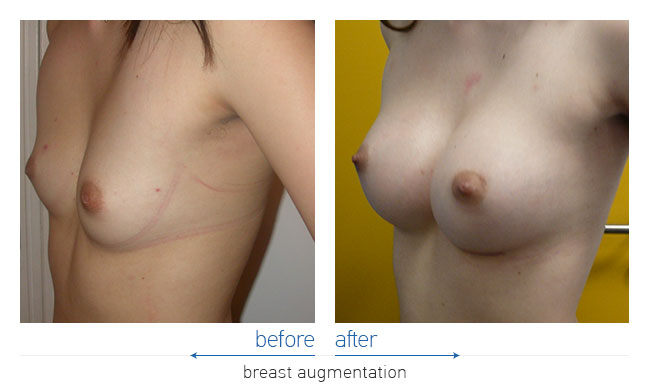 Breast Augmentatntion Before and After