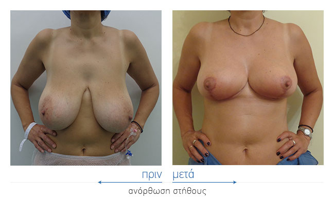 Breast Reduction Before and After