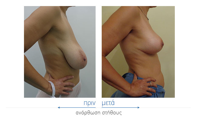 Breast Reduction Before and After