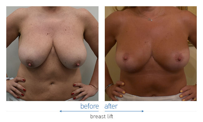 Breast Reduction Before and After