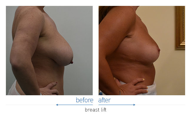 Breast Reduction Before and After