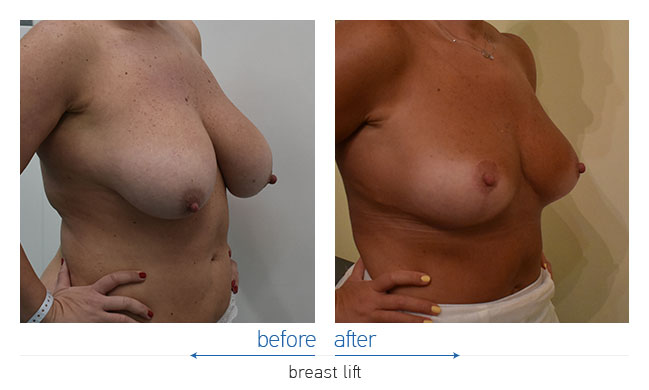 Breast Reduction Before and After