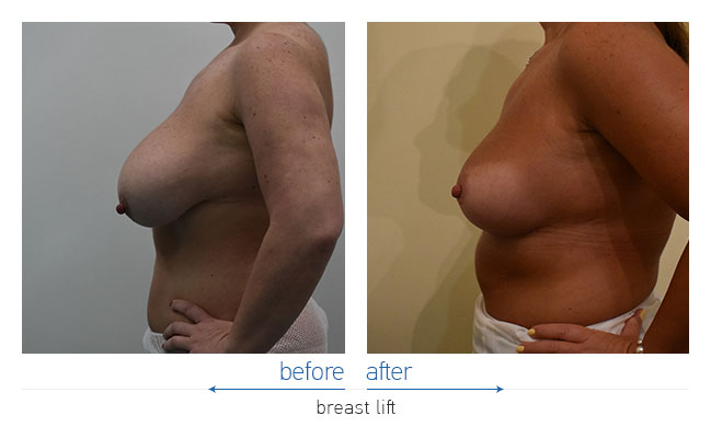 Breast Reduction Before and After