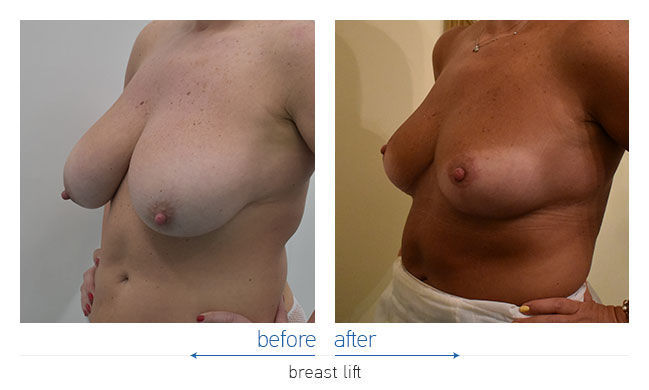 Breast Reduction Before and After